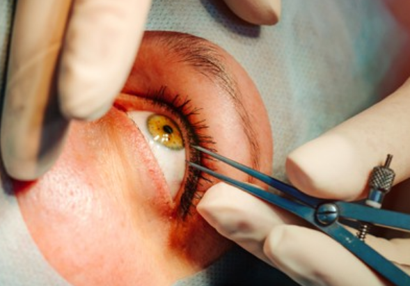 Cataract Surgeon in Aurangabad